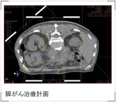 膵がん治療計画