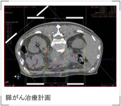 膵がん治療計画