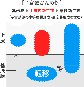 子宮頸がんの例