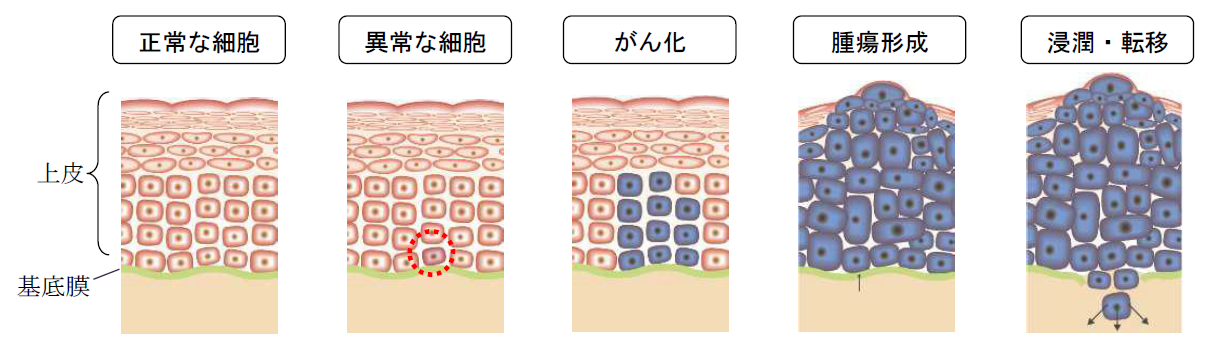 上皮内新生物